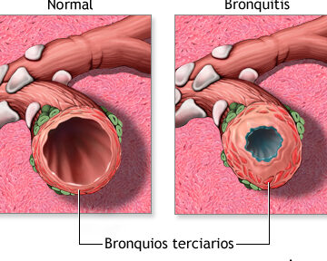 Bronquios dilatados: todo lo que debes saber sobre esta condición