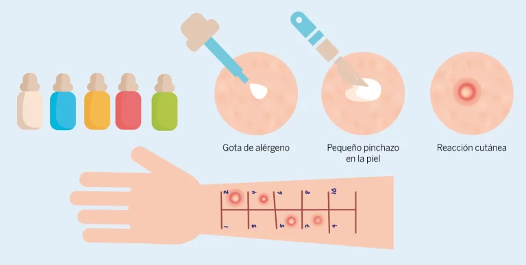 Controles positivos y negativos en el prospecto del test de alergia por punción HAL ALLERGY