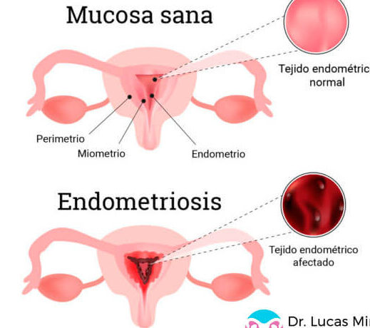 Endometriosis: Qué es, síntomas y tratamiento