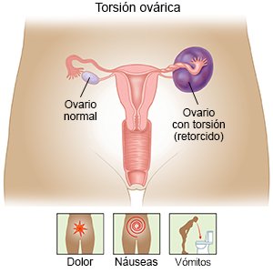 Pergoveris: tratamiento y prevención de la torsión ovárica grave